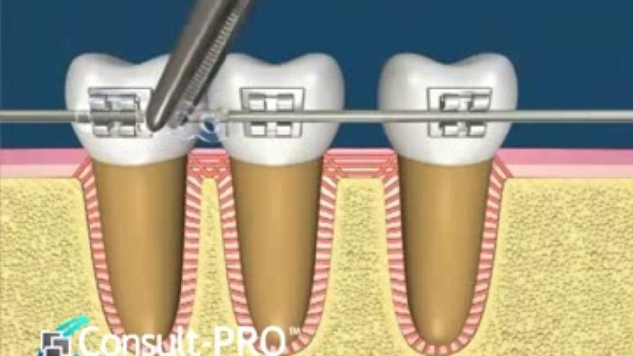 Ortodontik Tedavilerde Diş Hareketleri
