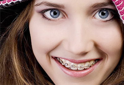 Ortodontik Tedavilerde Ağız Hijyeni Nasıl Sağlanmalıdır?