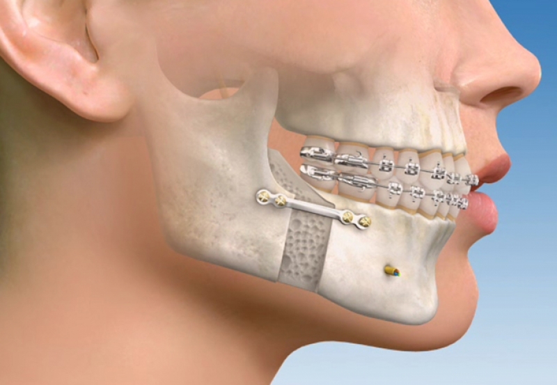 Ortognatik Cerrahi (Cerrahi Ortodonti) Nedir?